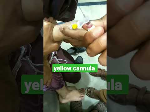 how to place yellow cannula in infant